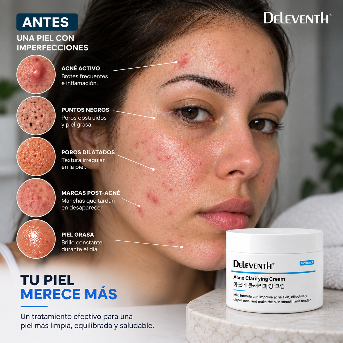 DELEVENTH — CREMA ANTIACNÉ PARA BROTES E IMPERFECCIONES